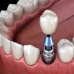 benefits of dental implants, dental implants, Jonesboro Dental Care, dental care in Jonesboro AR, Dr. Jonathan Cook, Dr. Mark Kingston, oral health, tooth replacement, bone preservation, dental implant care