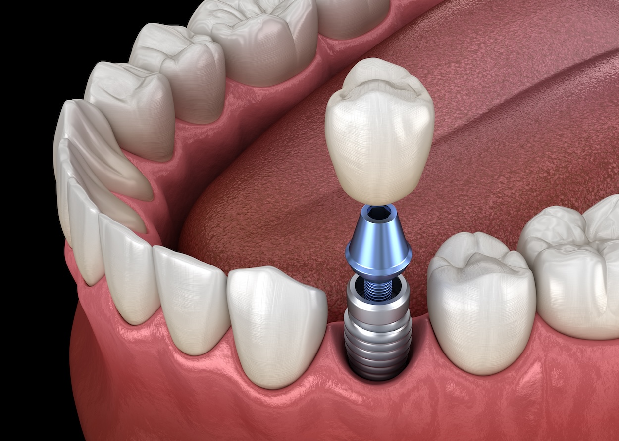 benefits of dental implants, dental implants, Jonesboro Dental Care, dental care in Jonesboro AR, Dr. Jonathan Cook, Dr. Mark Kingston, oral health, tooth replacement, bone preservation, dental implant care